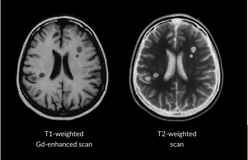 Image of two MRI brain scans. The brain on the left has text that says – T1-weighted Gd-enhanced scan. The brain on the right has text that says – T2-weighted scan
